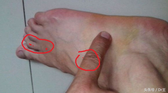 足部疼痛您都了解吗,足部反射区疼痛原因