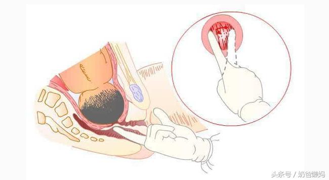 女人生孩子开几指才能顺产,生孩子骨缝开几指能生