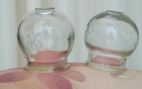 根据拔罐后皮肤的颜色鉴定你的身体到底是怎么了