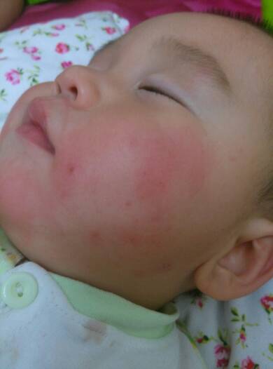 孩子食物过敏需要吃药吗,孩子食物过敏要不要去幼儿园