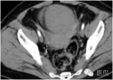 病例丨病理结果「医看」有奖阅片大赛病例资料8：右侧卵巢纤维瘤#医学影像#
