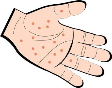 一点都不“单纯”的单纯性疱疹,中医却能轻松搞定!