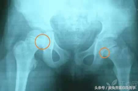 正常骨盆x线片详解,骨科医生只看报告单
