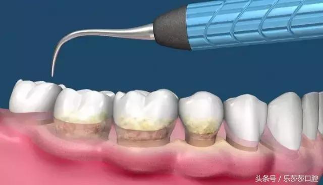 牙齿越长越往外凸怎么办,牙齿越来越长怎么回事