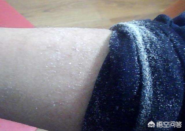 冬天身上有一层白白的皮屑，脱秋裤时像雪花纷纷落下，如何去除？