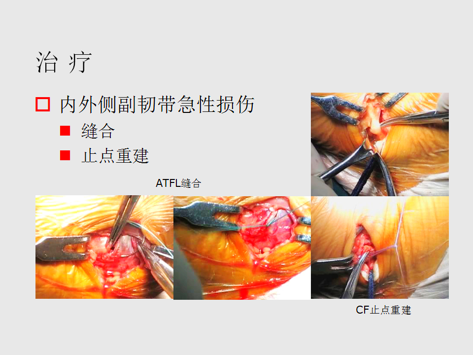 脚崴了怎么办判断是否骨折,脚崴了怎么办视频