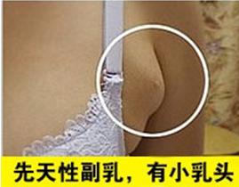 腋窝下有淋巴结会引起乳腺癌吗,腋下淋巴结会是乳腺癌吗