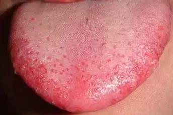 舌头不好,心脏不好会导致舌头有哪些症状