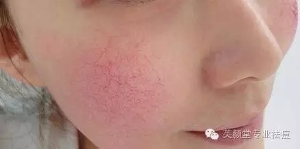 一到晚上脸部发红发烫怎么回事,冬天脸部发红发烫怎么快速缓解