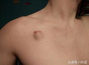 颈部淋巴疼痛但彩超没有显示,颈部肩部肌肉酸痛头晕ct还没事