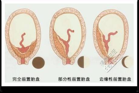 中央型前置胎盘大出血发生概率,怀孕六个月胎盘前置突然大出血