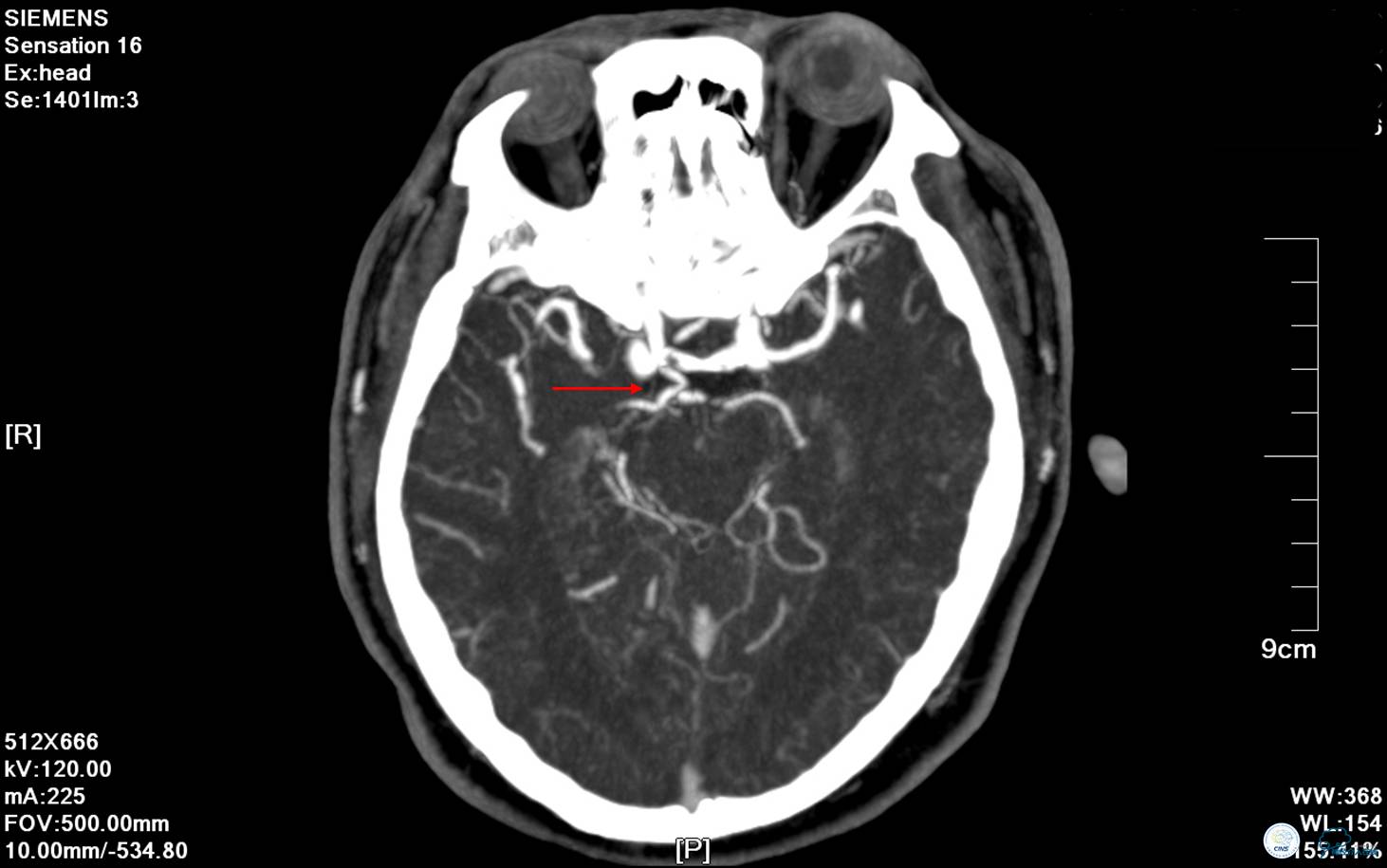 中医治疗基底动脉闭塞,基底动脉尖综合征病例分享