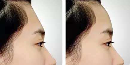 自体脂肪丰额头效果,自体脂肪丰额头效果只有3年