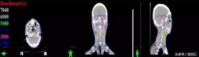 胡超苏治疗鼻咽癌案例,胡超苏鼻咽癌案例