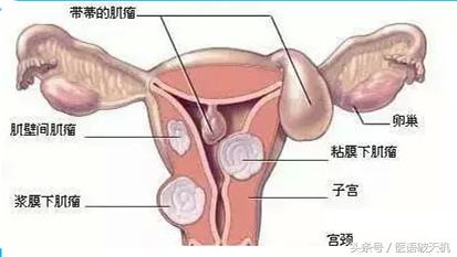 妇科最常见的肿瘤，到底应该怎么办