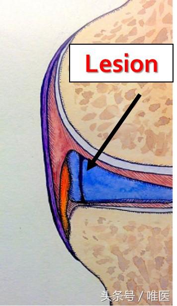 膝关节内侧后角半月板1度损伤,右膝关节内侧半月板后角变性损伤