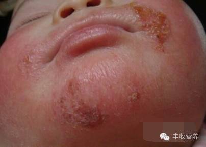治疗宝宝湿疹家长请收好调理食谱,宝宝湿疹怎么给宝妈解释