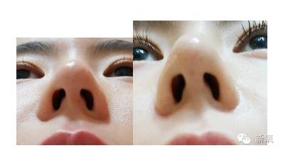 林允是不是整鼻子了,林允隆鼻过吗