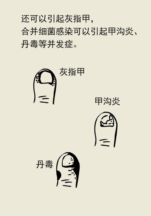 不臭不痒的脚气病,只痒无其他任何症状是脚气吗