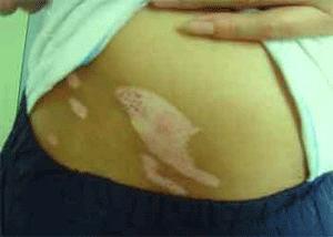 308激光治疗白癜风医保报销吗,uvb和308治疗白癜风哪个效果好