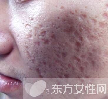 怎么祛痘疤最有效的方法,如何祛痘印痘疤效果最好