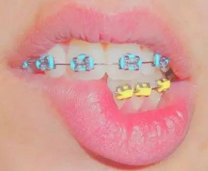 牙套戴橡皮筋怎么才能缓解疼痛,怎么戴牙套上的橡皮筋