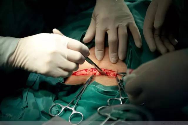 剖腹产恢复很好的照片,剖腹产完全恢复照片