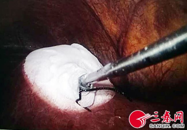 开展经皮介入肿瘤冷冻消融术,江苏省肿瘤医院氩氦刀冷冻消融术