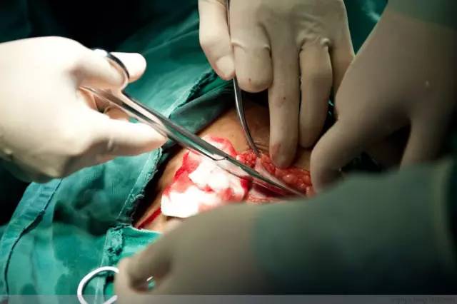 剖腹产恢复很好的照片,剖腹产完全恢复照片