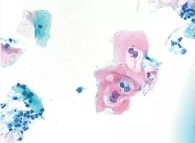 细胞形态符合低度上皮内病变,低度鳞状上皮内病变的临床意义