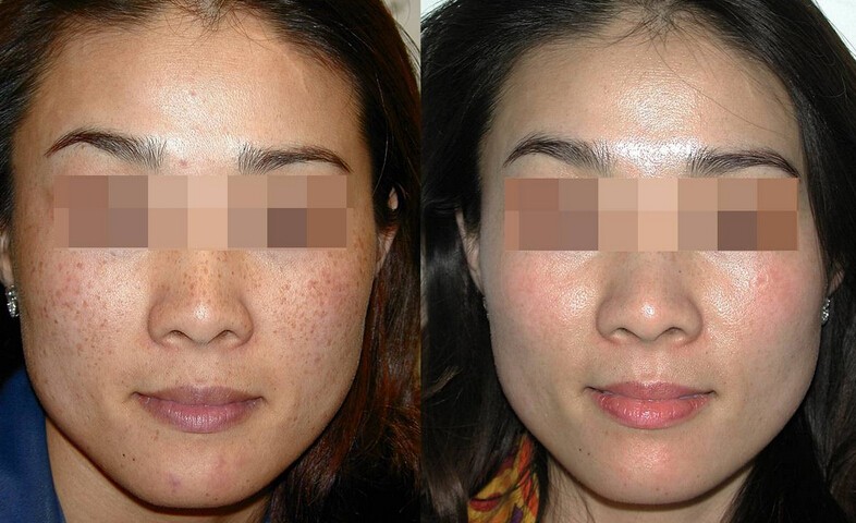 激光祛斑科普你想知道的一切,皮秒和激光哪个祛斑效果最好