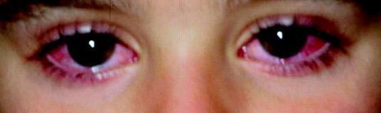 儿童川崎病持续高烧能降下来吗,孩子反复发烧出皮疹要小心川崎病