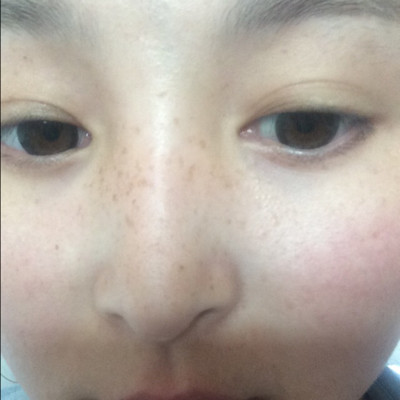 我生完孩子脸上长斑了怎么办,生完孩子后脸上长斑怎么调理