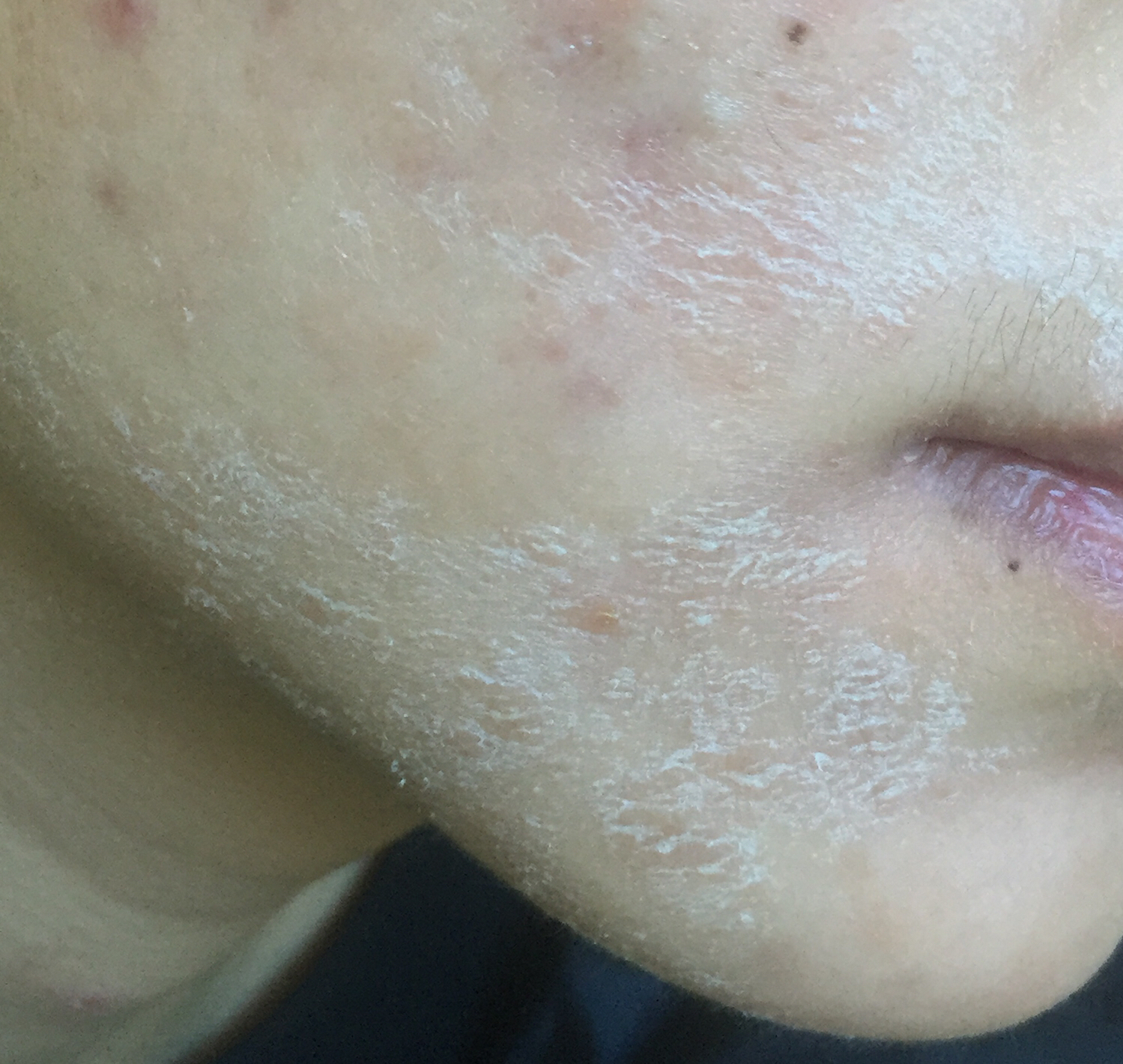 果酸治疗青春痘有副作用吗,青春痘药膏推荐无副作用