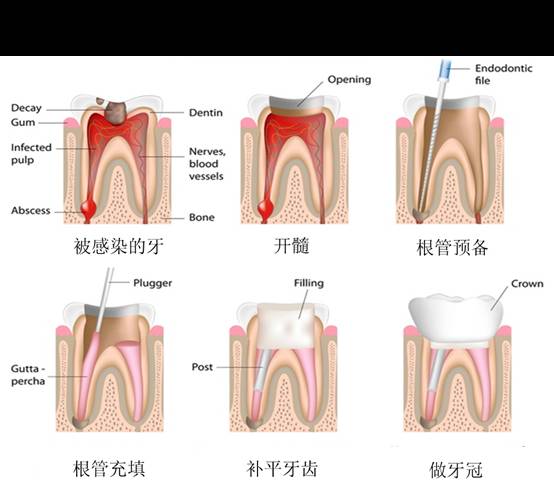 乳牙蛀了要处理吗,不用换的乳牙蛀了怎么办