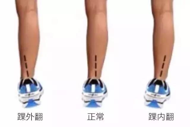 选择跑鞋内翻足和外翻足区别,选鞋不当危害