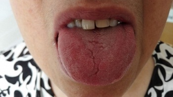 舌头有突起是什么病,舌头有这些表现或是疾病征兆