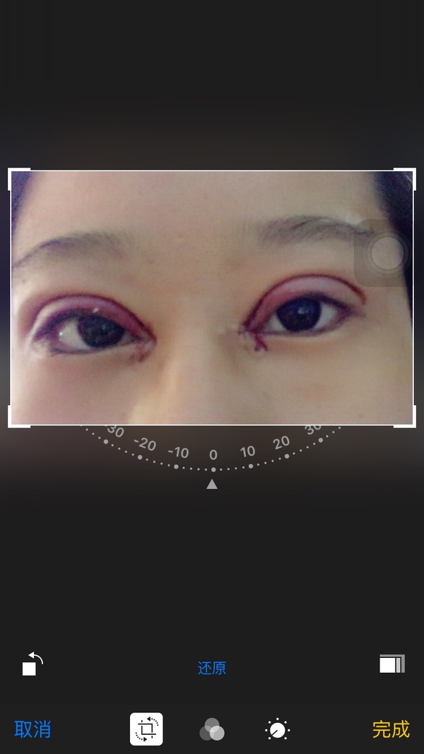 双眼皮手术第五天碰到水怎么办,双眼皮手术前感冒了怎么办