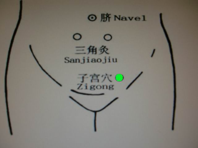 经期之痛，怎么解决痛苦，或许只有针灸才能一劳永逸！