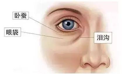 有泪沟怎么办最有效方法,有泪沟怎么办
