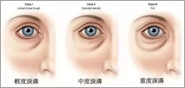 泪沟深怎么办,有了泪沟怎么补救