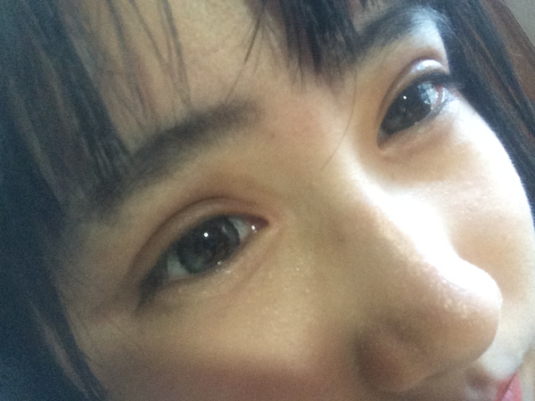 割完双眼皮后眼部吸脂,抽脂双眼皮做完眼睛有褶