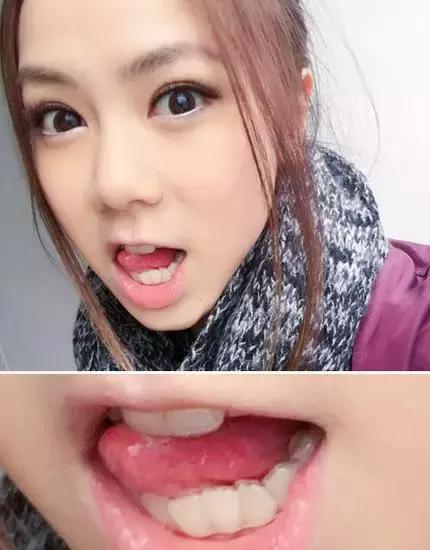 整牙刘涛,整牙改变脸型杨幂