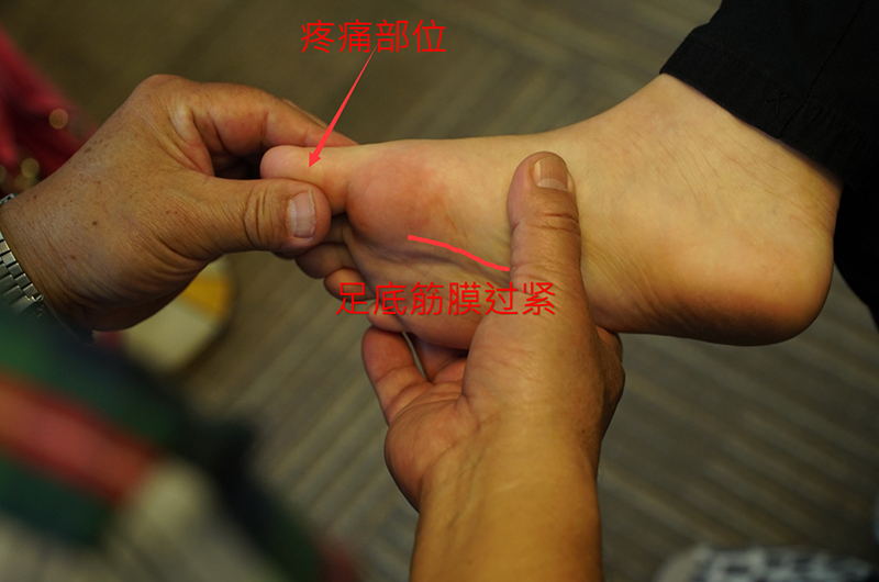 足底筋膜炎原是高弓足惹祸