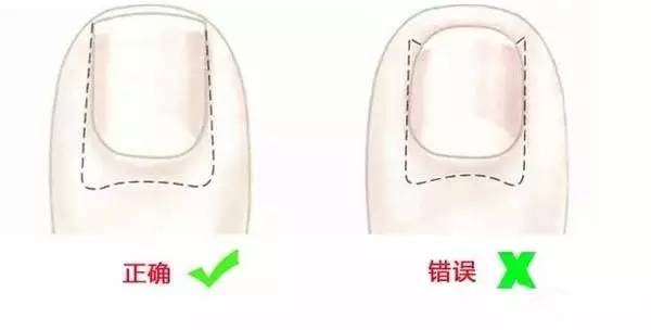 婴儿化脓甲沟炎最简单处理方法,宝宝甲沟炎指甲下有脓