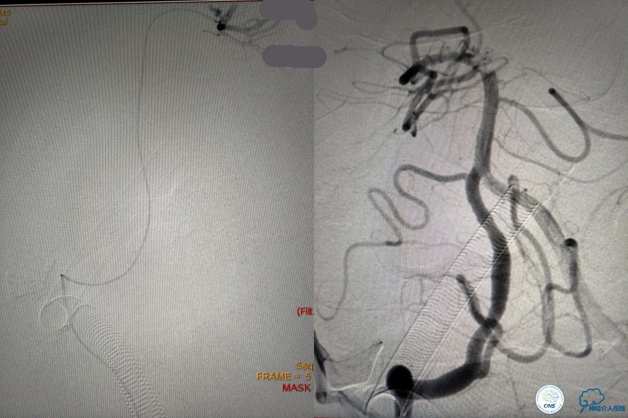 一例急性基底动脉尖综合征患者的支架取栓治疗