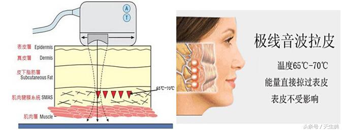 超声刀值得做吗 (超声刀怎么样啊)