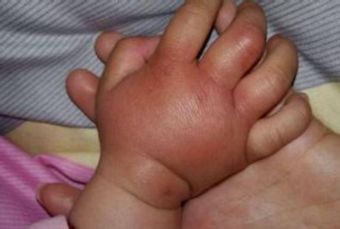 如何判断三岁孩子过敏严重程度,三岁小孩脸红肿是过敏了吗