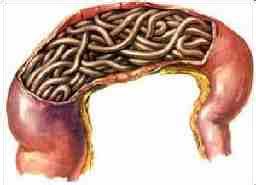 小孩肚子里有蛔虫如何处理,孩子肚子里有蛔虫怎么除掉