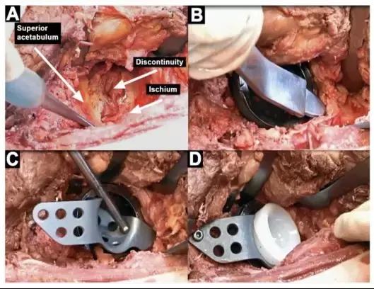 髋臼底严重骨缺损怎么翻修,髋臼骨缺损2厘米能愈合吗
